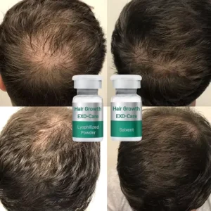 2/5/8billion Scalp Serum for Thinning Bald Hair Scalp Care Growth Tonics Hair Loss Serum Alopecia Lyophilized EXO Hair Regrowth
