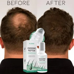 Custom LOGO EXO Hair Growth Serum Effective Anti Loss Hair Treatment Regrowth Oil Repair Hair Growth Serum for Men and Women