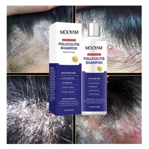 Customized Folliculitis Shampoo Seborrheic Dermatitis Shampoo Scalp Psoriasis Folliculitis Shampoo