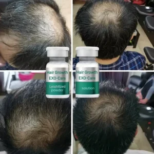 Exos Promote Hair Alopecia Treatment Growth Solution Freeze Dried Powder 2Billion Exos Stem Cells Serum for Bald Hair Regrowth