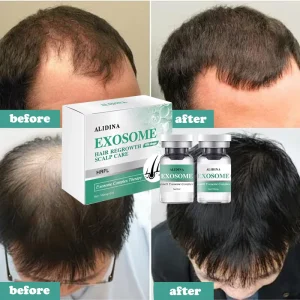 Hair Loss Therapy Actives Peptide Stem Cell Hair Regrowth Follicle Repair Scalp Care Kit Exo Hair Growth Stem Cell Therapy