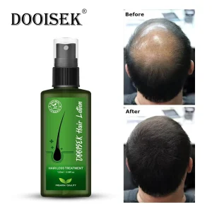 OEM 120ml Hair Regrowth Treatment Herbal Biotin Hair Growth Tonic Spray Hair Lotion