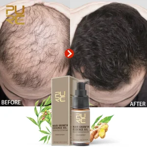 Organic Ginger Hair Growth Oil Serum for Women Men Anti Hair Loss Treatment Natural Fast Grow Hair Regrowth Oil