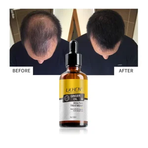Private Label Bald Hair Treatment Serum Ginger Oil Fast Hair Growth Treatment for Men Women