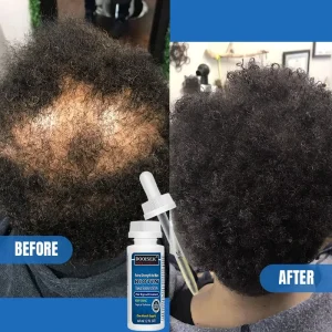 Spot Product Herbal Essence Serum Hair Regrowth Advasi Oil Natural Hair Growth Preventing Hair Loss 5%